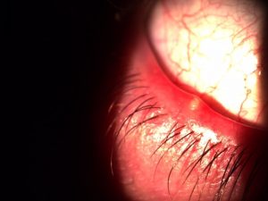 meibomian cyst in eye lid